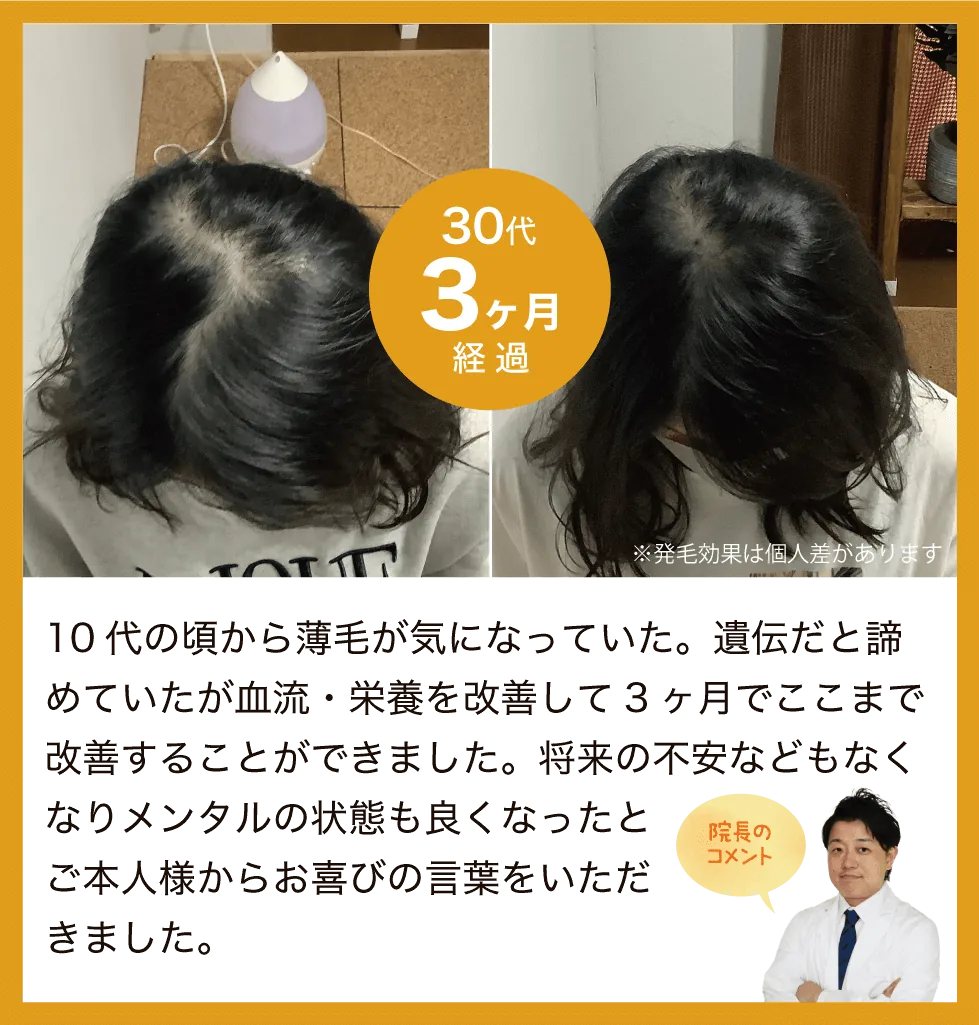 10代の頃から薄毛が気になっていた。遺伝だと諦めていたが血流・栄養を改善して3ヶ月でここまで改善することができました。将来の不安などもなくなりメンタルの状態も良くなったとご本人様からお喜びの言葉をいただきました。