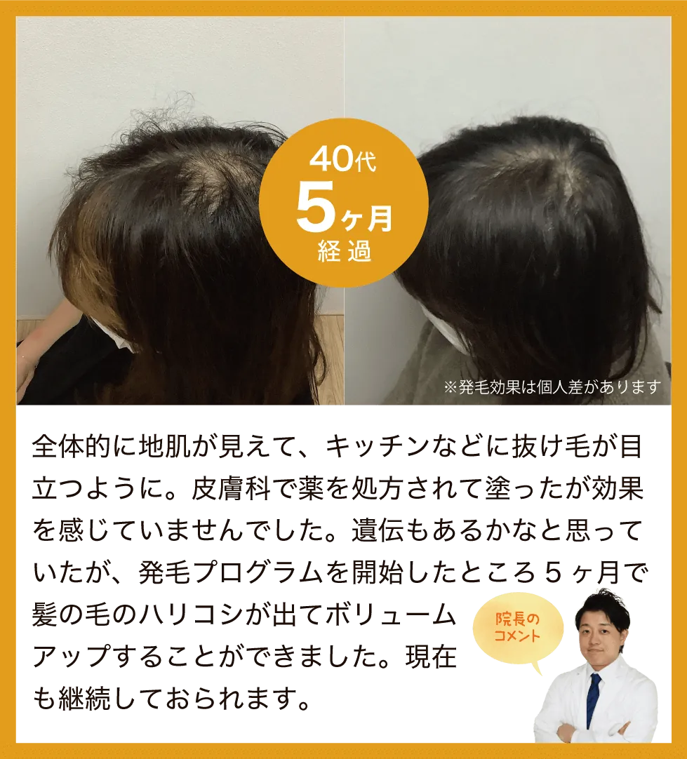 全体的に地肌が見えて、キッチンなどに抜け毛が目立つように。皮膚科で薬を処方されて塗ったが効果を感じていませんでした。遺伝もあるかなと思っていたが、発毛プログラムを開始したところ5ヶ月で髪の毛のハリコシが出てボリュームアップすることができました。現在も継続しておられます。