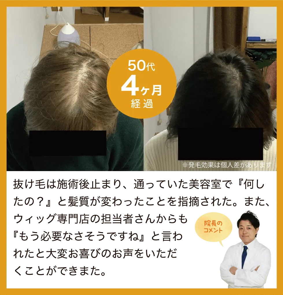 抜け毛は施術後止まり、通っていた美容室で『何したの？』と髪質が変わったことを指摘された。また、ウィッグ専門店の担当者さんからも『もう必要なさそうですね』と言われたと大変お喜びのお声をいただくことができまた。