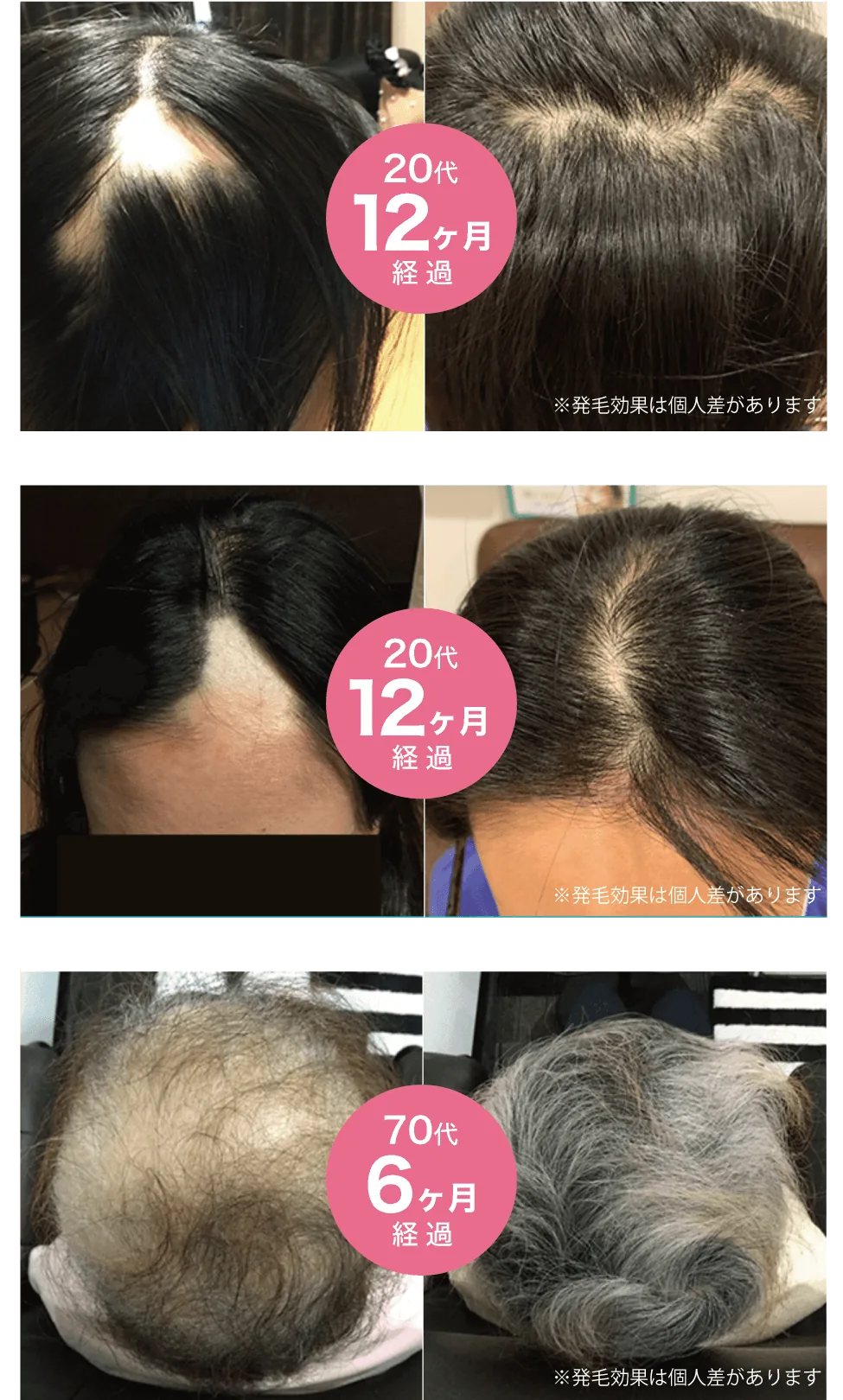 来院された方の施術前後の分け目と頭頂部の写真（20代・12か月、20代・12か月、70代・6か月経過）