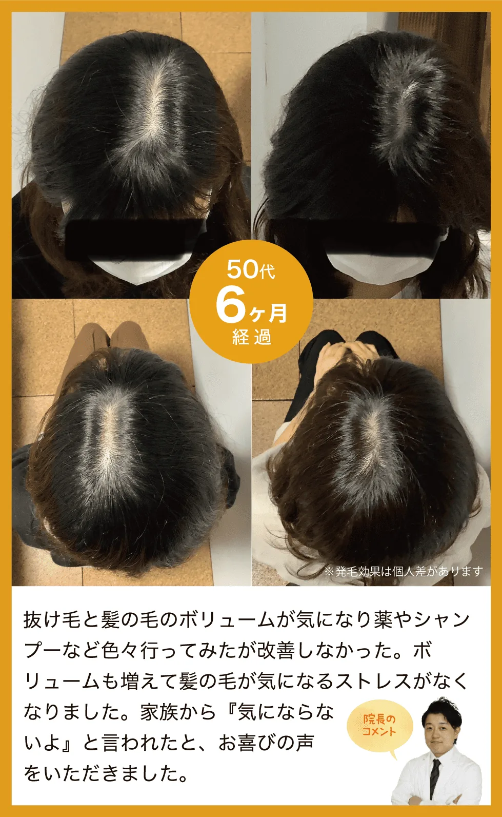 抜け毛と髪の毛のボリュームが気になり薬やシャンプーなど色々行ってみたが改善しなかった。ボリュームも増えて髪の毛が気になるストレスがなくなりました。家族から『気にならないよ』と言われたと、お喜びの声をいただきました。