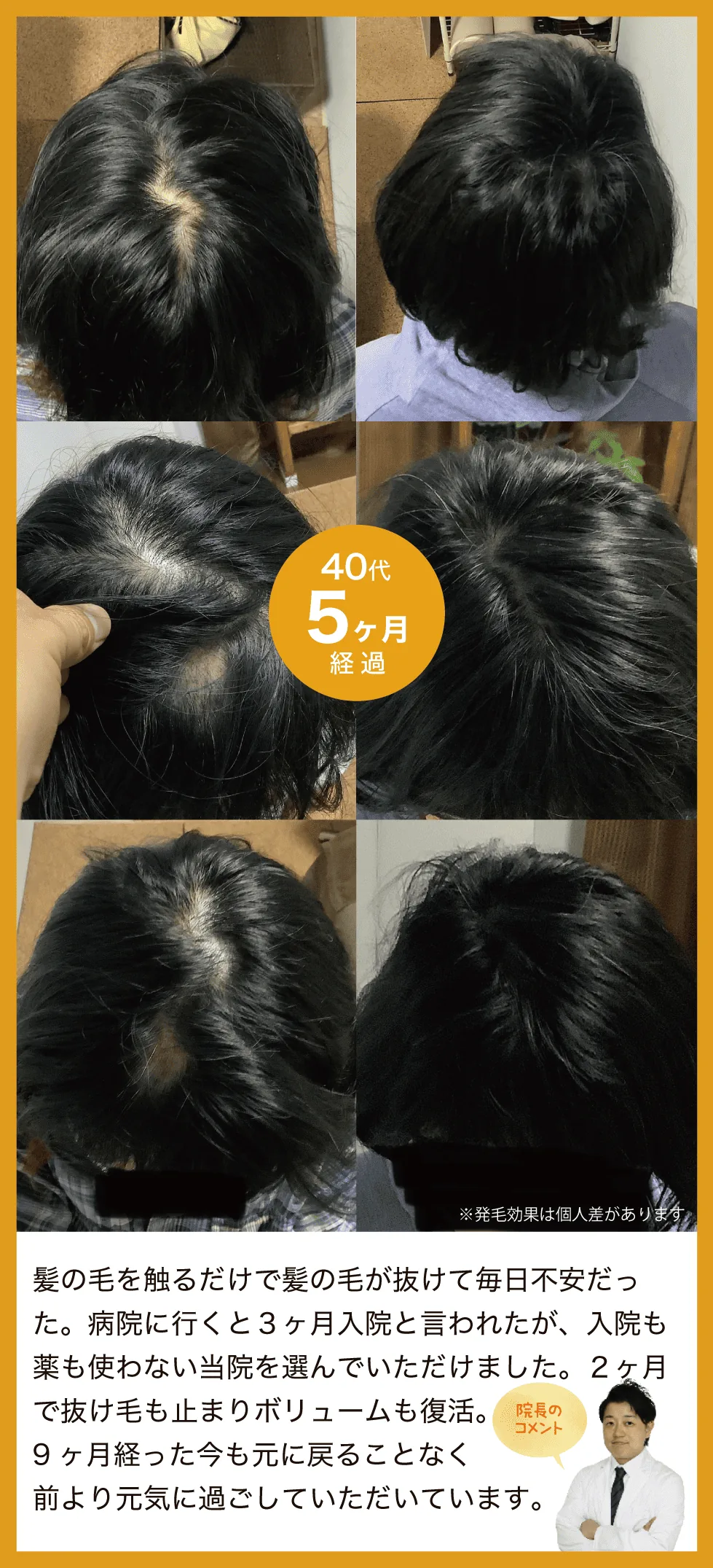 髪の毛を触るだけで髪の毛が抜けて毎日不安だった。病院に行くと３ヶ月入院と言われたが、入院も薬も使わない当院を選んでいただけました。２ヶ月で抜け毛も止まりボリュームも復活。9ヶ月経った今も元に戻ることなく前より元気に過ごしていただいています。