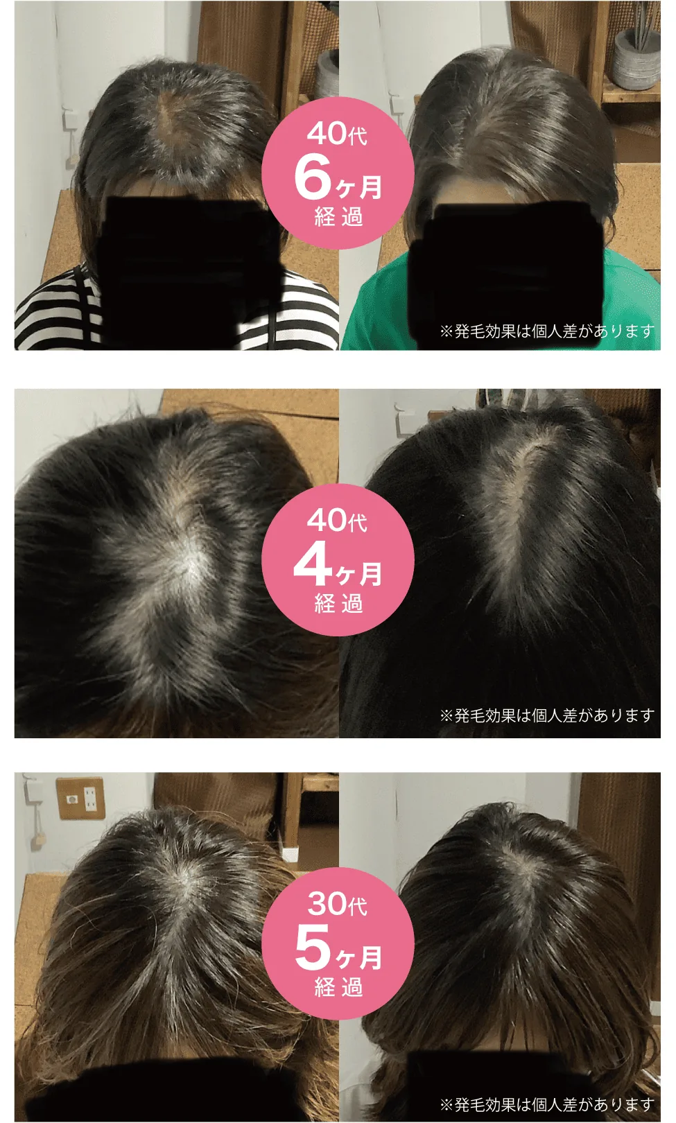 来院された方の施術前後の頭頂部の写真（40代・6か月、40代・4か月、30代・5か月経過）
